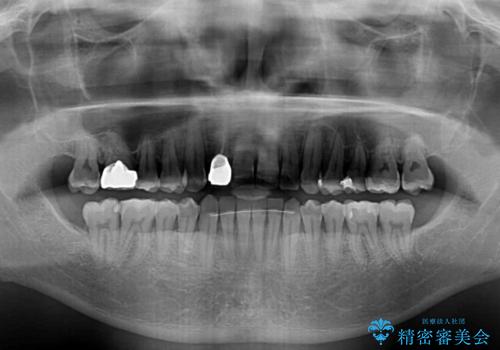 治療途中の前歯を治したい インビザライン矯正とオールセラミッククラウンの治療後