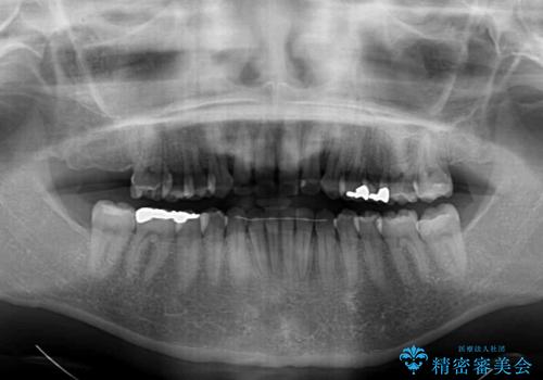 【モニター】前歯のデコボコをインビザラインできれいに整えるの治療後