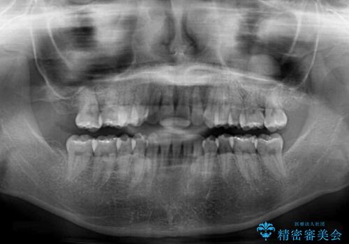 変則的な抜歯矯正 八重歯を抜いてしまった人のワイヤー矯正の治療後