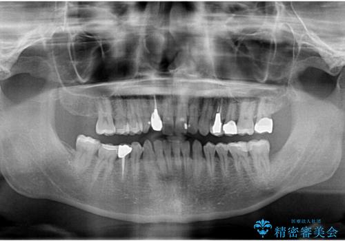 銀歯だらけの口の中を改善したいの治療後