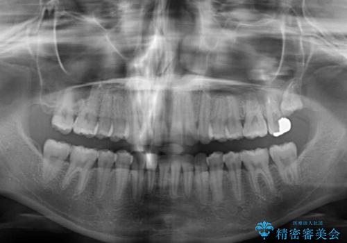 飛び出した前歯と黄ばんだ歯 ホワイトニングしながらマウスピース矯正の治療後