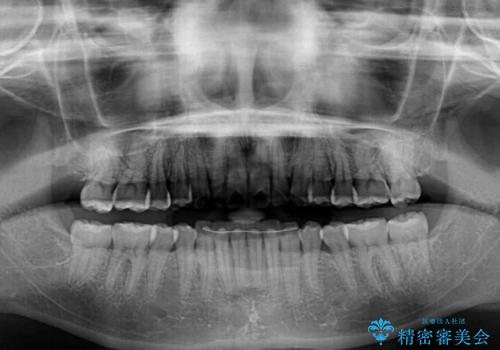 インビザラインを断念 ワイヤー装置で楽々と矯正治療の治療後