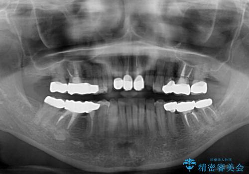 奥歯の銀歯と歯並びを改善　歯周外科治療と矯正治療を行った総合歯科診療の治療後
