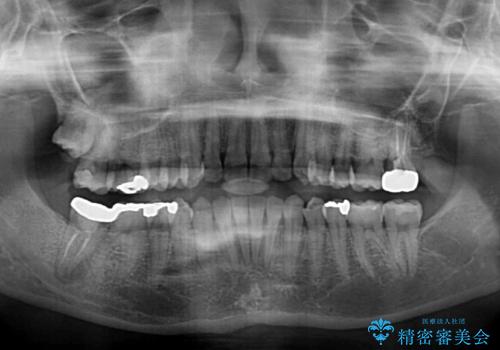 入国制限で帰国できず 海外出張中のインビザライン矯正の治療後