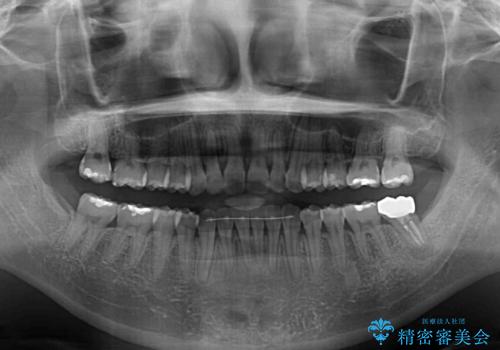 前歯のデコボコをインビザラインでスッキリと仕上げるの治療後