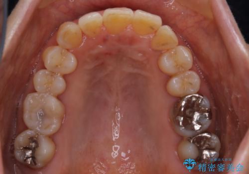 下の前歯が見えない:深い噛み合わせもインビザラインでの治療後