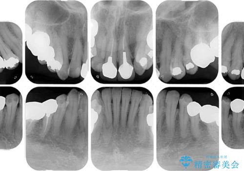 奥歯の銀歯と歯並びを改善　歯周外科治療と矯正治療を行った総合歯科診療の治療前