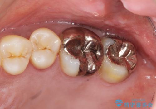 段差の気になる銀歯を改善したいの症例 治療前