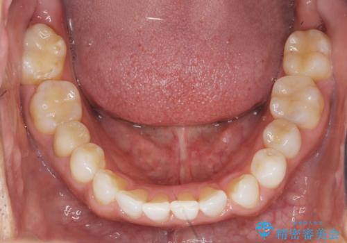 銀歯だらけの口の中を改善したいの治療後