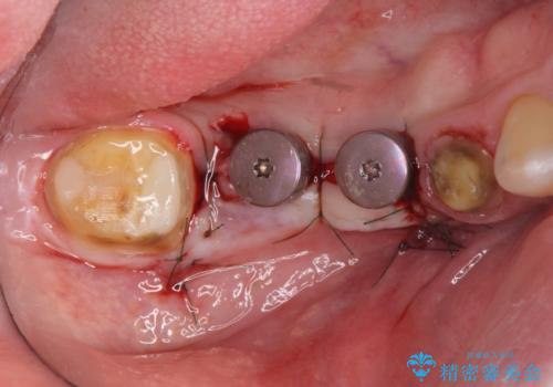 長いブリッジをインプラント補綴への変更の治療中