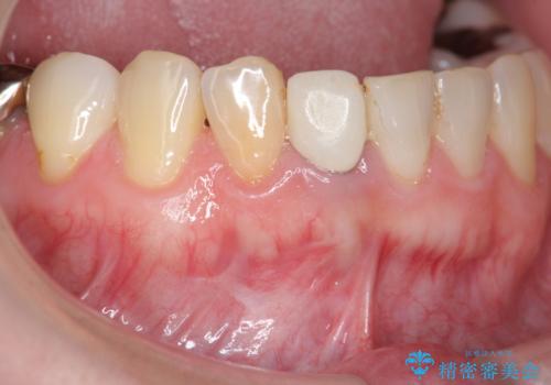 [ 歯ぐきを押すと痛む ]　根管治療の必要な前歯治療の症例 治療前