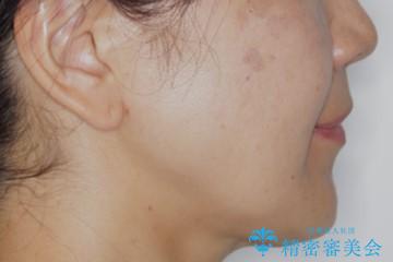 下の前歯が見えない:深い噛み合わせもインビザラインでの治療前(顔貌)