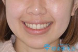 オープンバイト(開咬)を非抜歯インビザラインで治すの治療後(顔貌)