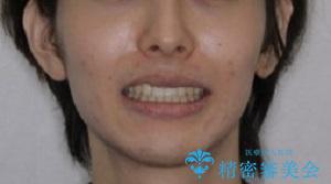 オーディションで歯並びを指摘された:自信をもって歌える口元への治療後(顔貌)