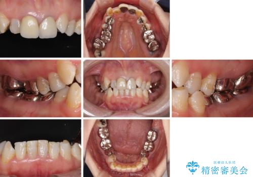 奥歯の銀歯と歯並びを改善　歯周外科治療と矯正治療を行った総合歯科診療の治療前