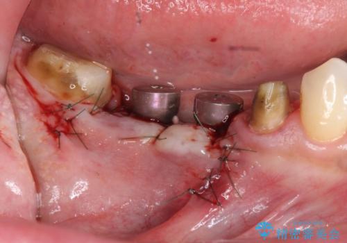 長いブリッジをインプラント補綴への変更の治療中