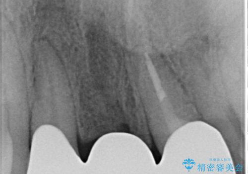 【オールセラミックスタンダード】前歯のブリッジの治療後