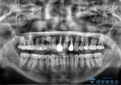 後戻りした歯並びをきれいにしたいの治療後