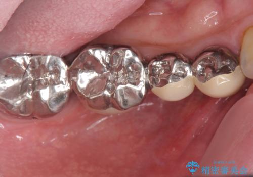 長いブリッジをインプラント補綴への変更の治療前