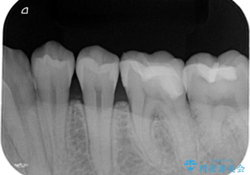 【セラミックインレー】虫歯の治療の治療後