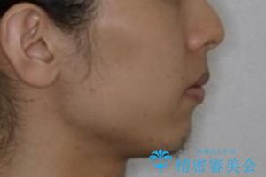 オーディションで歯並びを指摘された:自信をもって歌える口元への治療前(顔貌)