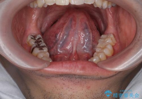 [ 滑舌の改善 ] 即日可能な舌小帯形成の治療前