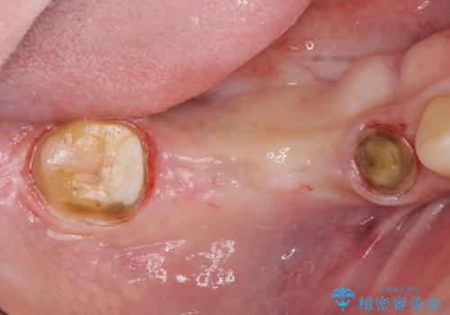 長いブリッジをインプラント補綴への変更の治療中