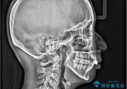 後戻りした歯並びをきれいにしたいの治療後