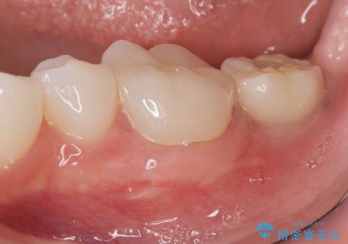 [ インプラント治療 ]  失った歯の咬合機能回復の症例 治療後