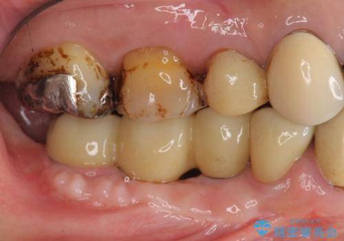 薄い骨幅 骨造成 歯肉移植を併用したインプラント治療の治療後