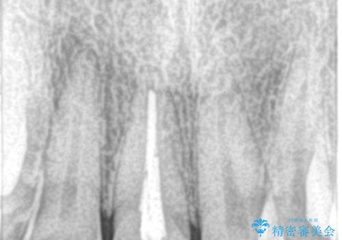 セラミックによる前歯の変色の改善の治療前