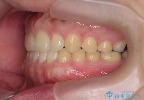 インビザラインで行うカモフラージュ矯正の治療後