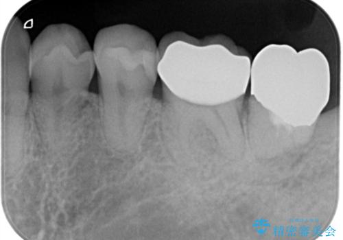 金属の詰め物がはずれた。の治療後