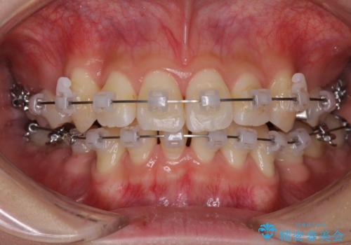 前歯の歯並びを治したい ワイヤー装置での抜歯矯正の治療中