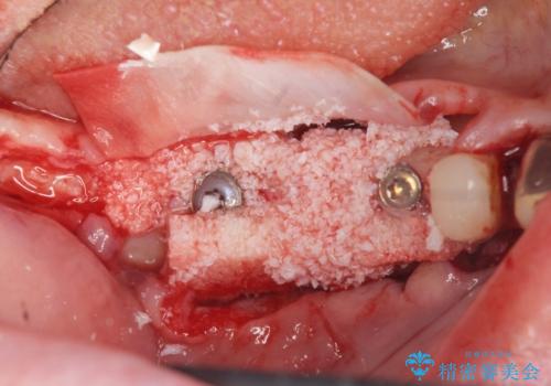 薄い骨幅 骨造成 歯肉移植を併用したインプラント治療の治療前