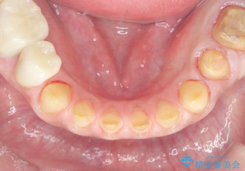 歯ぎしりですり減った 前歯の見た目を回復したいの治療中