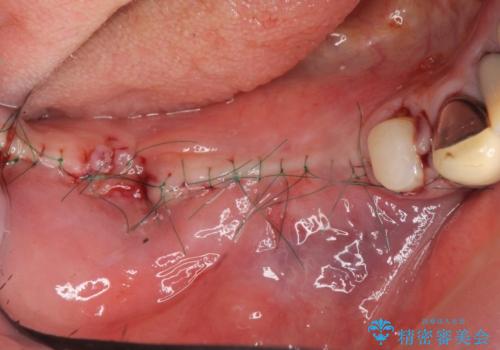 薄い骨幅 骨造成 歯肉移植を併用したインプラント治療の治療前
