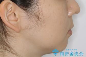 見た目だけじゃない:マウスピースでも短期間で噛み合わせと口元を改善の治療後(顔貌)