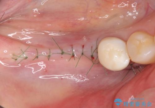 インプラント治療による咬合機能回復の治療中