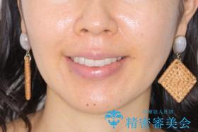 矮小歯を綺麗な歯に。矯正とセラミックの総合治療の治療後(顔貌)