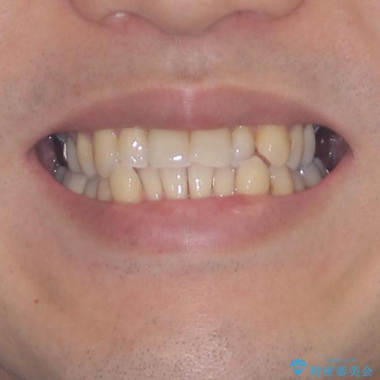 受け口傾向の咬み合わせ　前歯のデコボコをワイヤー矯正で素早く改善の治療前（顔貌）