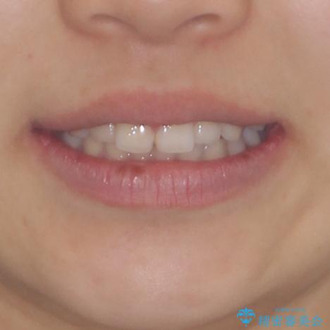 前歯のデコボコと突出感　インビザラインによる矯正治療の治療前（顔貌）