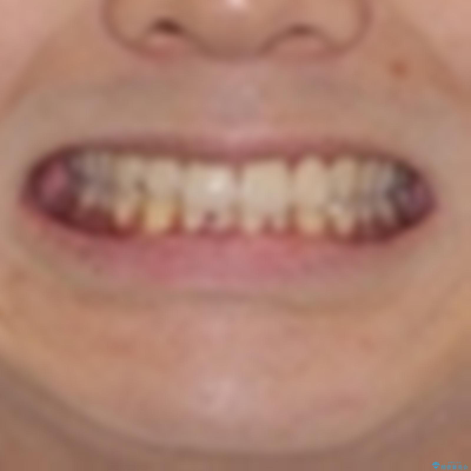 矯正治療の後戻りをインビザライン・ライトで解消の治療前(顔貌)