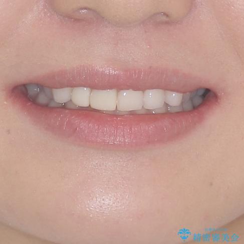 一度諦めた矯正にチャレンジしたい インビザラインとセラミック治療の治療前(顔貌)