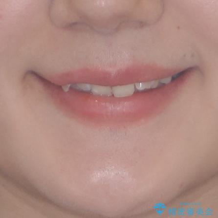 インビザライン単独では困難 補助装置を併用した矯正治療の治療前(顔貌)