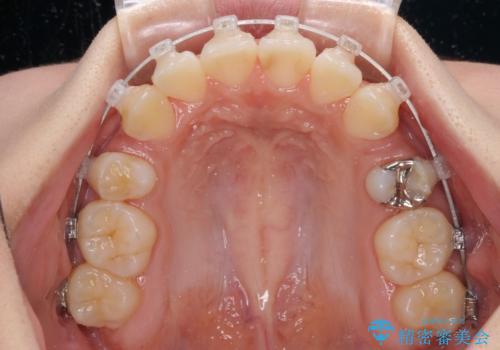 前歯の歯並びを治したい ワイヤー装置での抜歯矯正の治療中