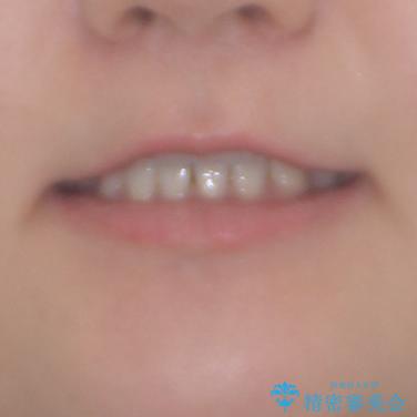 奥歯の欠損を放置　大臼歯を抜歯した矯正治療の治療前（顔貌）