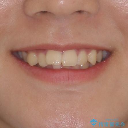 下の前歯が隠れてしまうほど深い咬み合わせ 高校生のインビザライン矯正治療の治療前(顔貌)