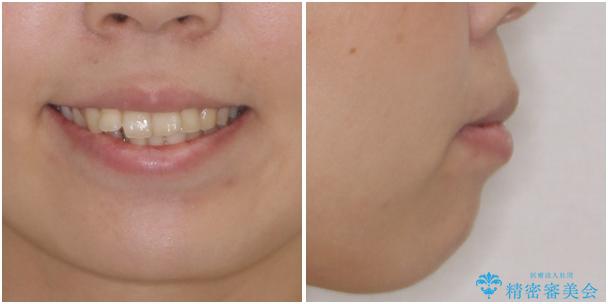 前歯の出っ歯と口の閉じにくさを抜歯矯正で改善 目立たないワイヤー矯正の治療前(顔貌)