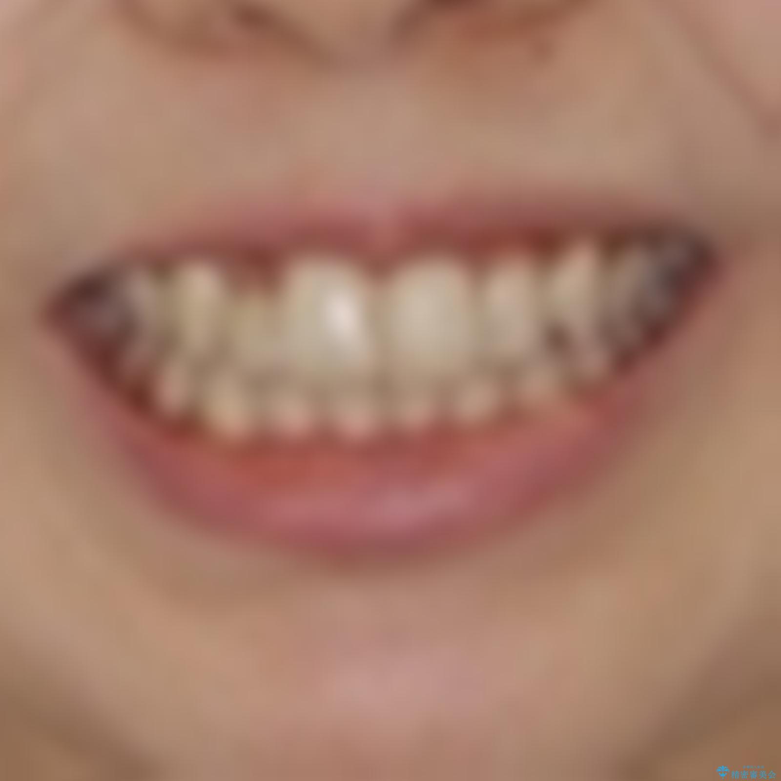 抜けてしまうと言われた前歯 インビザラインによる矯正治療の治療前(顔貌)